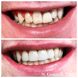 Before and after smile at Singing River Dentistry