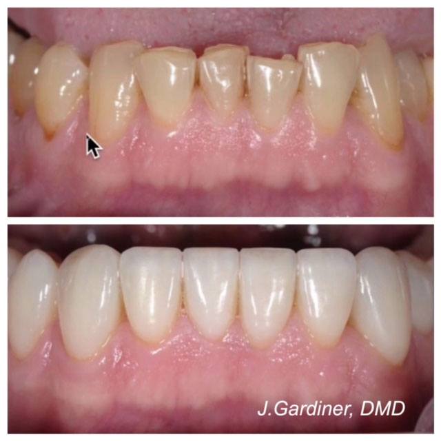 Before and after smile at Singing River Dentistry