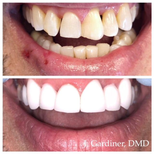 Before and after smile at Singing River Dentistry