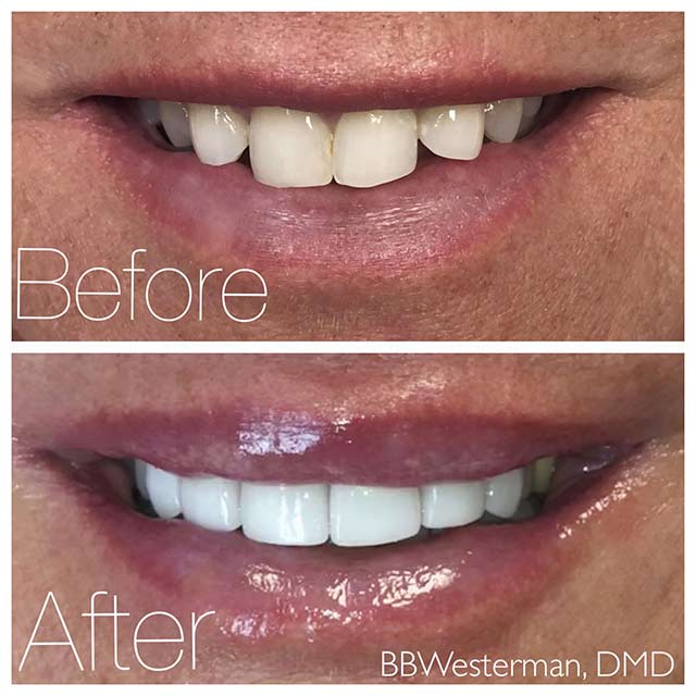 Before and after smile at Singing River Dentistry