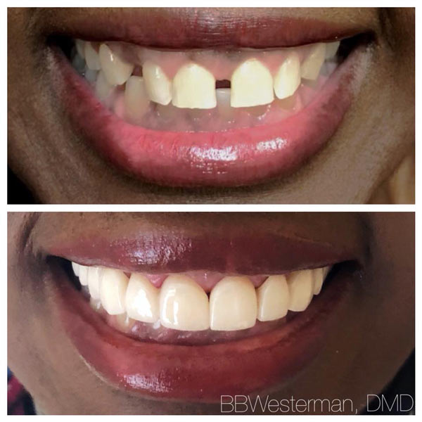 Before and after smile at Singing River Dentistry