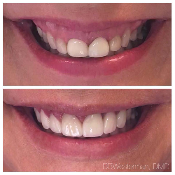 Before and after smile at Singing River Dentistry