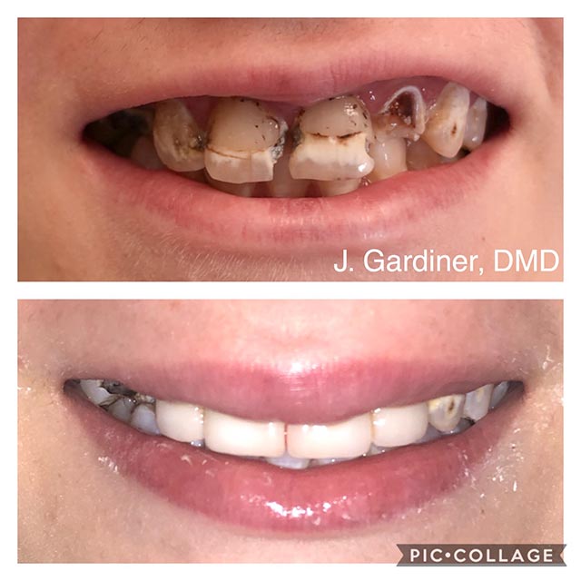 Before and after smile at Singing River Dentistry