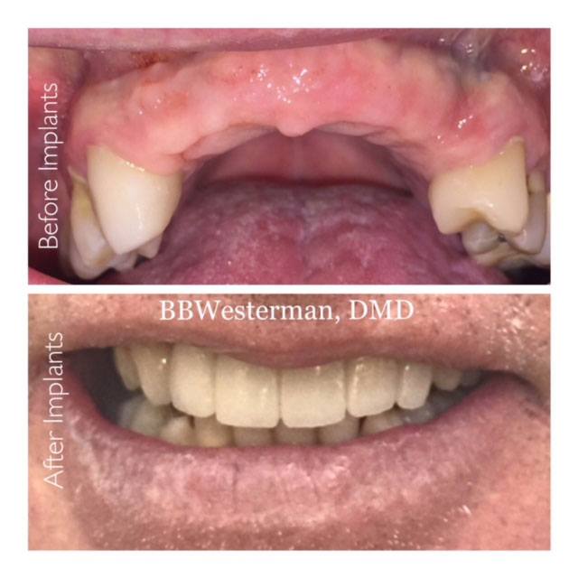 Before and after smile at Singing River Dentistry