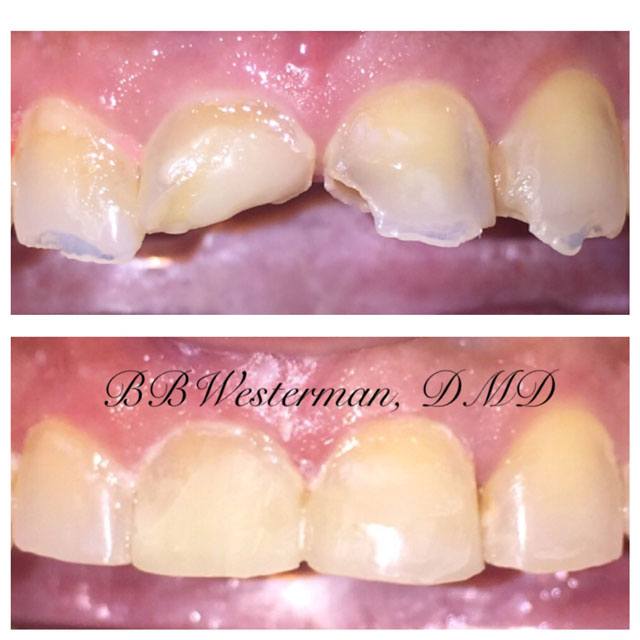 Before and after smile at Singing River Dentistry