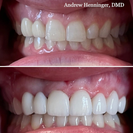 Before and after smile at Singing River Dentistry