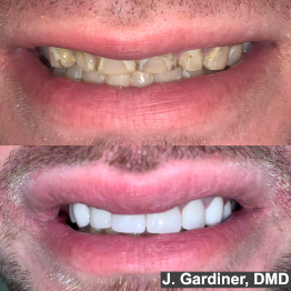Before and after smile at Singing River Dentistry