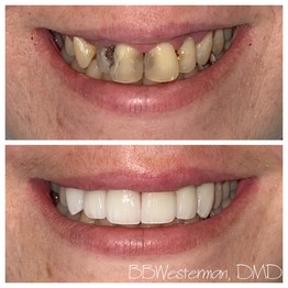 Before and after smile at Singing River Dentistry