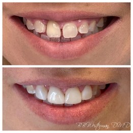 Before and after smile at Singing River Dentistry