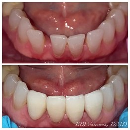 Before and after smile at Singing River Dentistry
