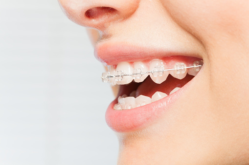 How to Care for Your Metal Braces