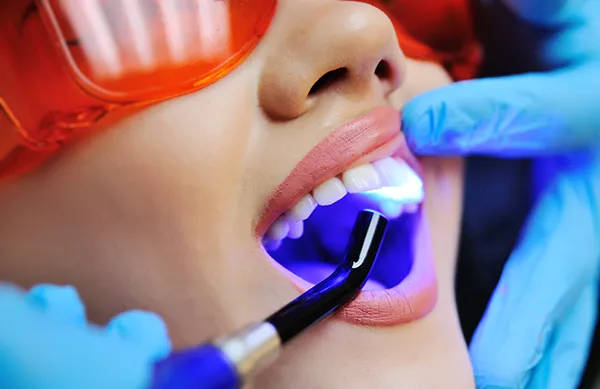 Close up of a dental assistant applying a UV light to a female patient's newly sealed teeth at Singing River Dentistry in Athens, AL