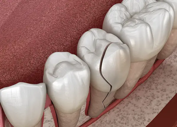 Close-up of a cracked molar tooth in the lower jaw, showing extensive damage to the enamel and dentin.