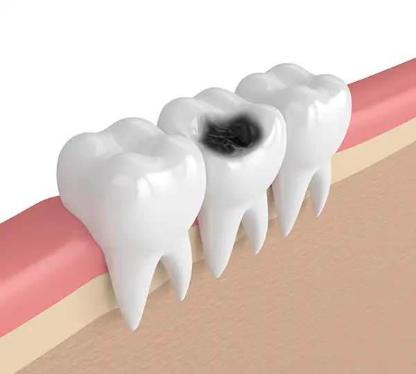 Close-up of three teeth with one showing visible decay and a cavity on the enamel.